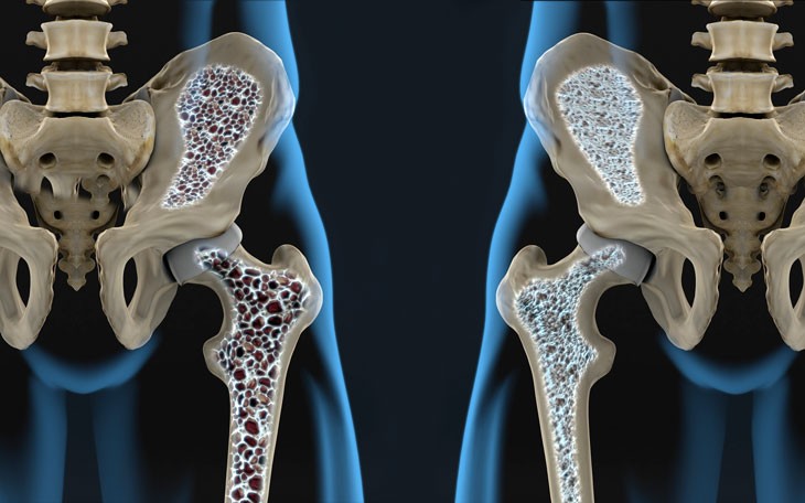 Osteoporose-Capa-730x456.jpg (68 KB)